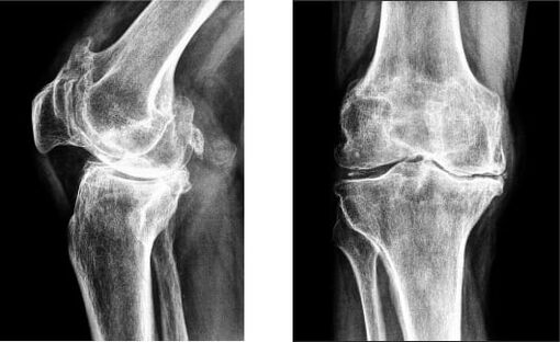 Gonartrosi dell'articolazione del ginocchio alla radiografia