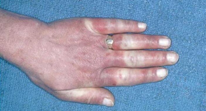 Quadro clinico della sindrome di Raynaud vasospasmo, iperemia, edema
